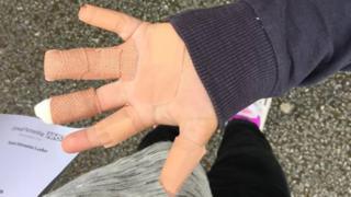 Finlay's hand
