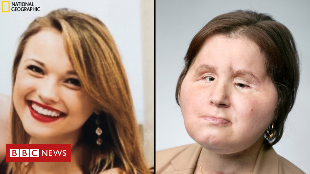 Face transplant: A 'second chance' for young suicide survivor