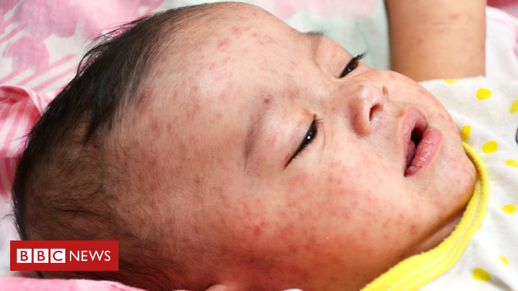 Measles circumstances hit document high in Europe