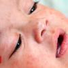 WHO caution as European measles fee jumps from file low