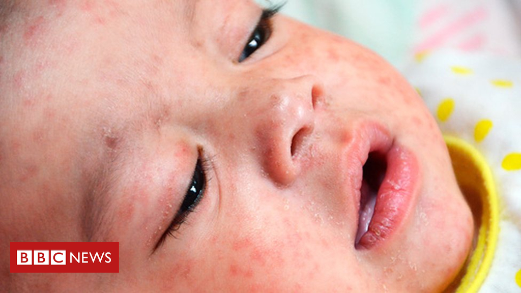 WHO caution as European measles fee jumps from file low