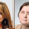 Face transplant: A 'second chance' for young suicide survivor