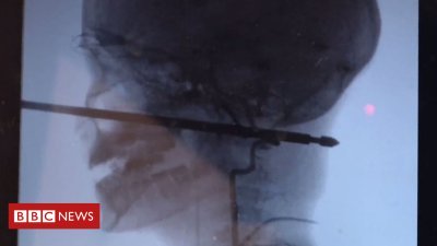 'Miracle' recovery for boy after meat skewer pierces head